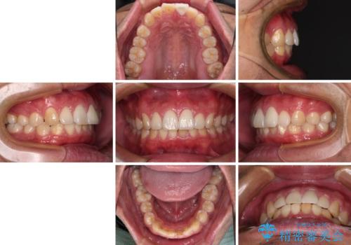 気になる前歯を短期間で改善 下顎の部分矯正と上顎のオールセラミッククラウンの治療後