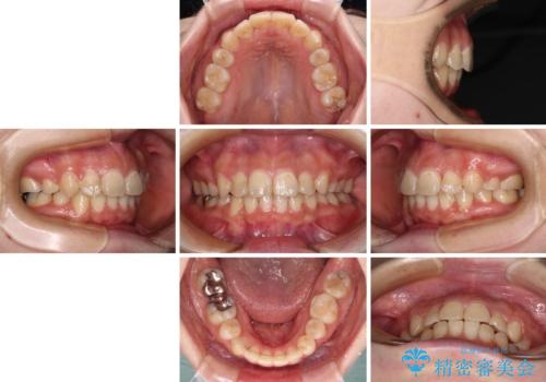 見えないほど重なっている前歯 抜歯矯正でスッキリとした歯並びにの治療後