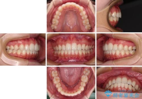 【モニター】前歯のクロスバイトをインビザラインで治療の治療後