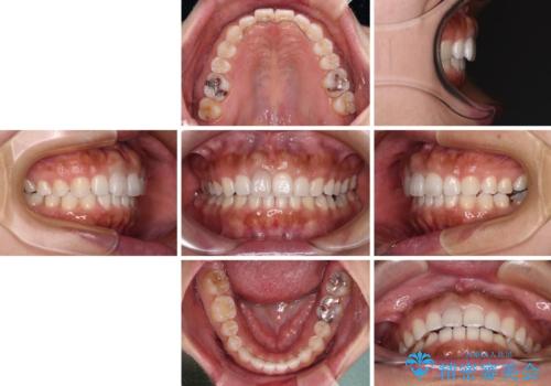 隙間の空いた前歯を閉じたい インビザライン矯正の治療後