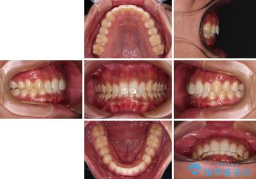 デコボコとディープバイトを治したい インビザラインによる矯正治療の治療後