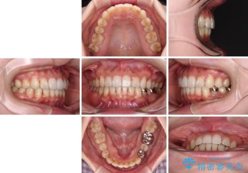 ディープバイトとデコボコを解消 インビザライン矯正の治療後