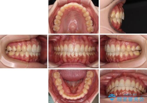 上下前歯の前歯と腫れやすい歯肉 インビザライン矯正で改善の治療後