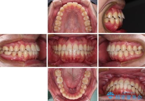 早くて安くて楽ちん メタルブラケットでの矯正治療の治療後