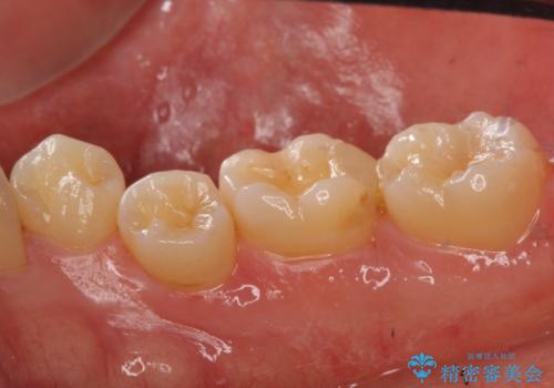 奥歯の詰め物の変色 セラミッククラウンでのやり替えの治療前