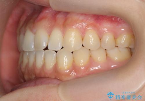 [ インビザライン ]前歯のねじれ、噛み合わせを治したいの治療後