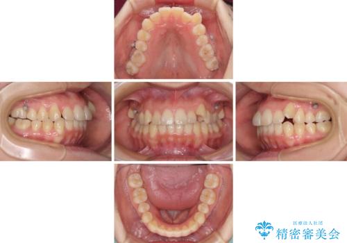 狭い歯列を拡大 拡大装置を併用したインビザライン矯正の治療中