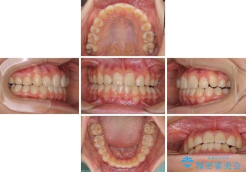 目立つ八重歯を治したい インビザラインによる矯正治療の治療中