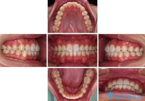 軽微叢生をインビザラインで 廉価版パッケージでの矯正治療の治療中