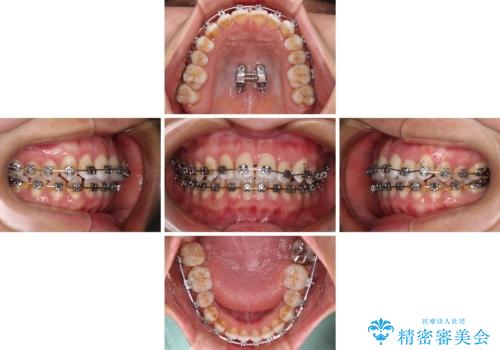 前歯の反対咬合　急速拡大装置とワイヤー装置であっという間の矯正治療の治療中