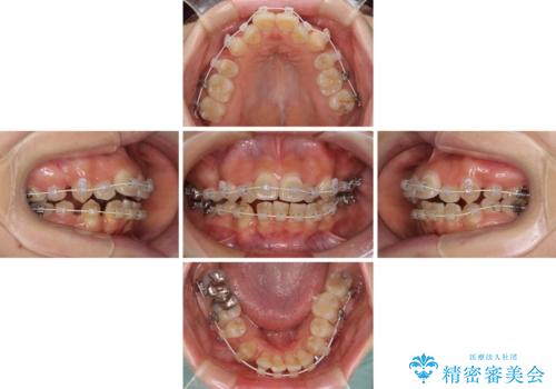 見えないほど重なっている前歯 抜歯矯正でスッキリとした歯並びにの治療中
