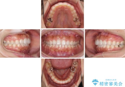 隙間の空いた前歯を閉じたい インビザライン矯正の治療中