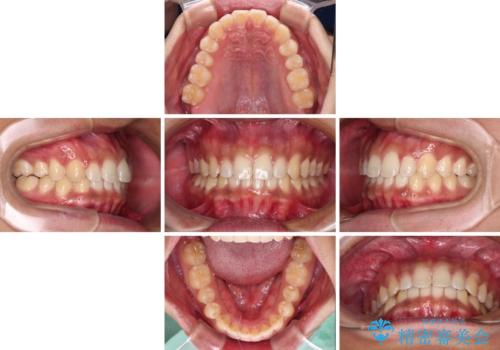 デコボコとディープバイトを治したい インビザラインによる矯正治療の治療中