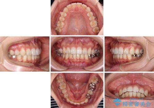 ディープバイトとデコボコを解消 インビザライン矯正の治療中