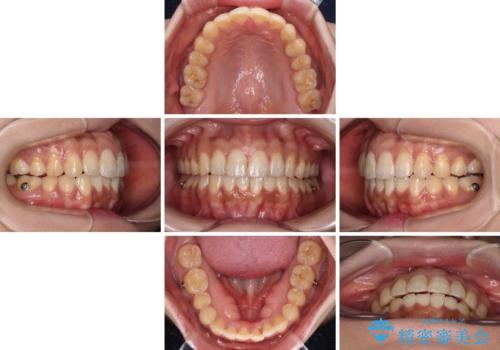 上下前歯の前歯と腫れやすい歯肉 インビザライン矯正で改善の治療中