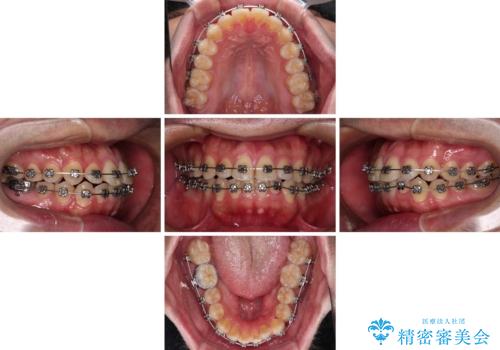 早くて安くて楽ちん メタルブラケットでの矯正治療の治療中