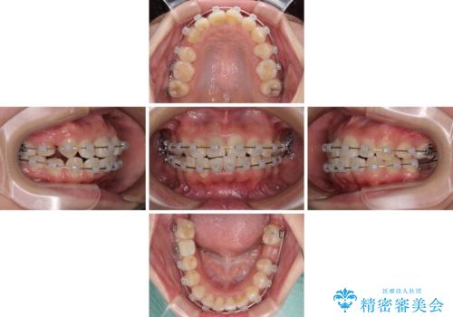 虫歯と抜いたままの奥歯とデコボコの前歯 総合歯科治療の治療中