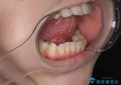 [ 舌小帯の形成 ]  滑舌の改善をしたいの症例 治療後