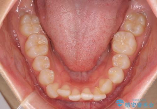 【モニター】前歯のクロスバイトをインビザラインで治療の治療前