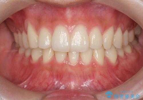 [ 下顎3前歯の矯正治療 ]  3インサイザー仕上げのマウスピース矯正の症例 治療後