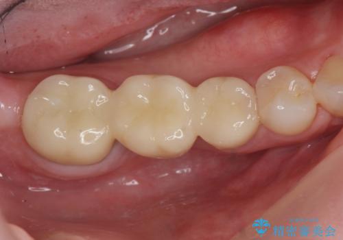 放置した虫歯 ブリッジ治療の治療後
