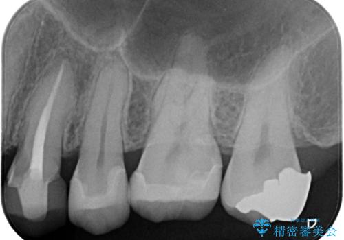 【保険治療したところが再び虫歯に】セラミックインレーで治療の治療後