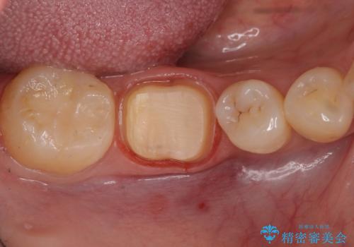欠けた詰め物 セラミッククラウンでの修復の治療中