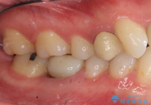 放置した虫歯 ブリッジ治療の治療前