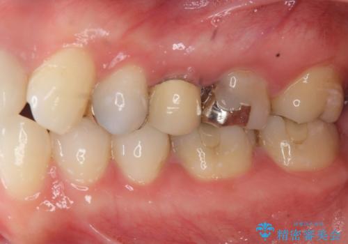 目立つ銀歯を白くしたいの治療前