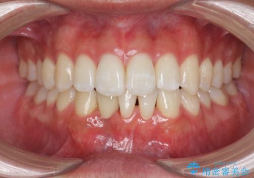 [ 先天性の前歯欠損 ]  マウスピース矯正とインプラント治療の治療後