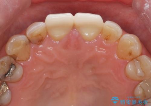 目立つ前歯の変色を改善したいの治療後