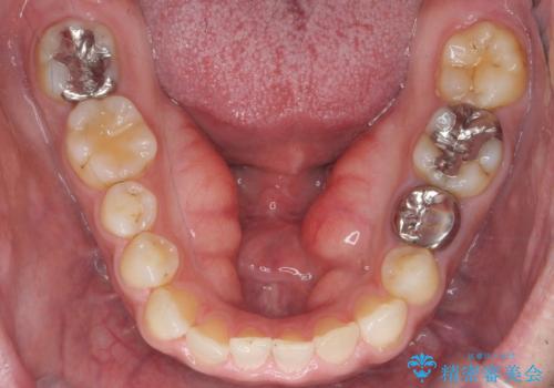 滑舌の悪さを　舌小帯形成術　で改善の治療後