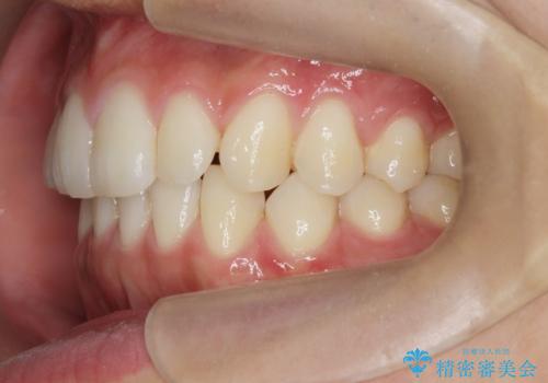 [ 下顎3前歯の矯正治療 ]  3インサイザー仕上げのマウスピース矯正の治療後