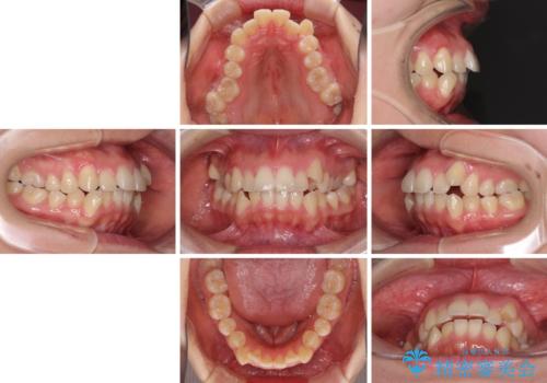 狭い歯列を拡大 拡大装置を併用したインビザライン矯正の治療前