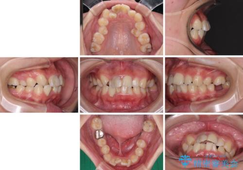 虫歯と抜いたままの奥歯とデコボコの前歯 総合歯科治療の治療前