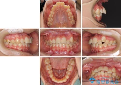 目立つ八重歯を治したい インビザラインによる矯正治療の治療前