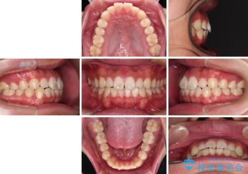 軽微叢生をインビザラインで 廉価版パッケージでの矯正治療の治療前