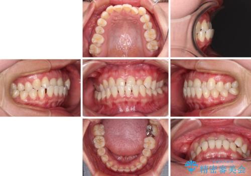 前歯の反対咬合 急速拡大装置とワイヤー装置であっという間の矯正治療の治療前