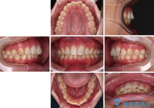 気になる前歯を短期間で改善 下顎の部分矯正と上顎のオールセラミッククラウンの治療前