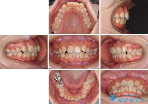 見えないほど重なっている前歯 抜歯矯正でスッキリとした歯並びにの治療前