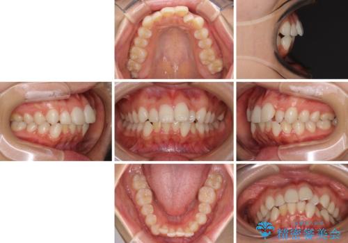 【モニター】前歯のクロスバイトをインビザラインで治療の治療前