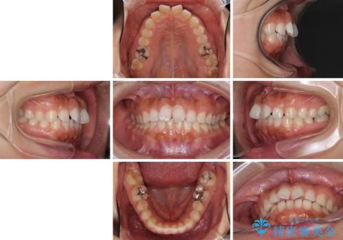 隙間の空いた前歯を閉じたい インビザライン矯正の治療前