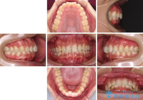 デコボコとディープバイトを治したい インビザラインによる矯正治療の治療前