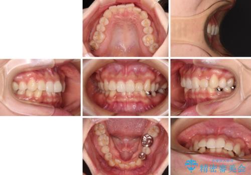 ディープバイトとデコボコを解消 インビザライン矯正の治療前