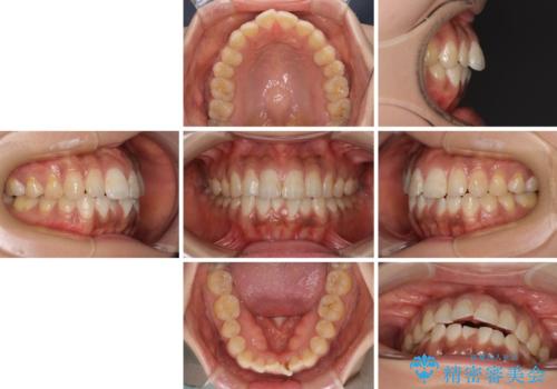 上下前歯の前歯と腫れやすい歯肉 インビザライン矯正で改善の治療前