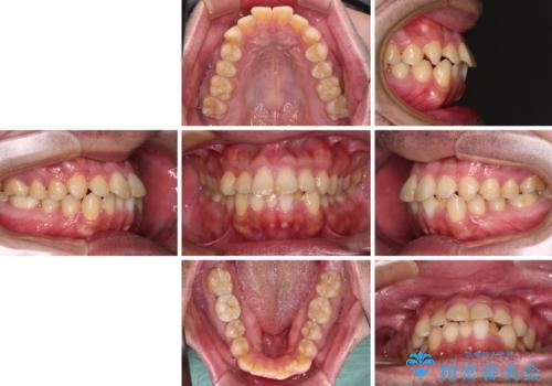 早くて安くて楽ちん メタルブラケットでの矯正治療の治療前