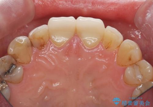 目立つ前歯の変色を改善したいの治療後