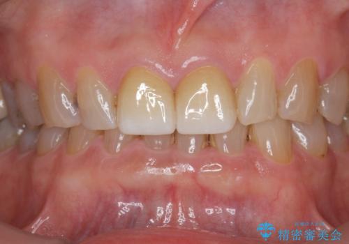 目立つ前歯の変色を改善したいの治療後