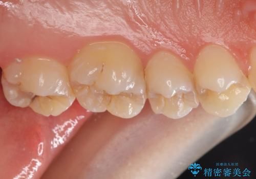 放置した虫歯 セラミックインレーでの治療の治療前