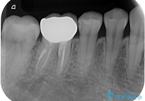 【精密根管治療】間違った根管形成→パフォレーションリペアによる修復 の治療後